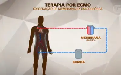 MC Marcinho usa terapia conhecida como ECMO, espécie de pulmão artificial; entenda como funciona