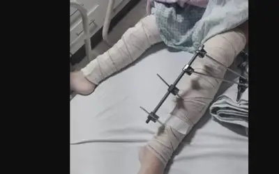 Menina de 6 anos tem pinos colocados em perna errada